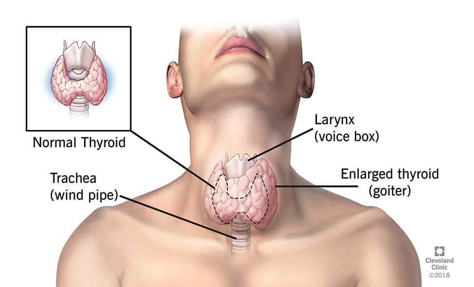 Hypothyroidism-Los-Angeles