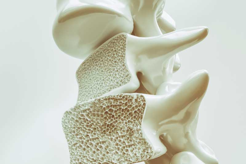 osteoporosis los angeles