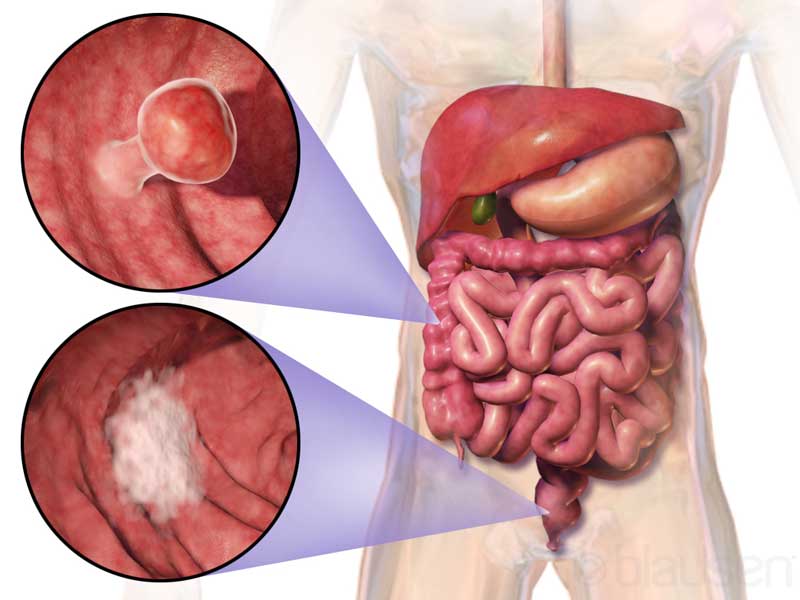 Los Angeles Colorectal Cancer