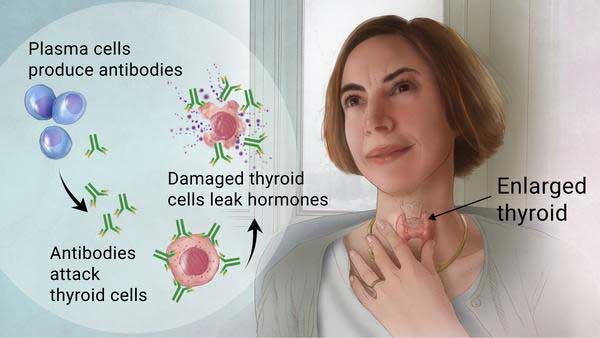 thyroid treatment torrance, ca | hashimotos disease