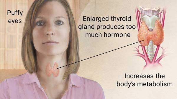 thyroid treatment torrance | hyperthyroidism